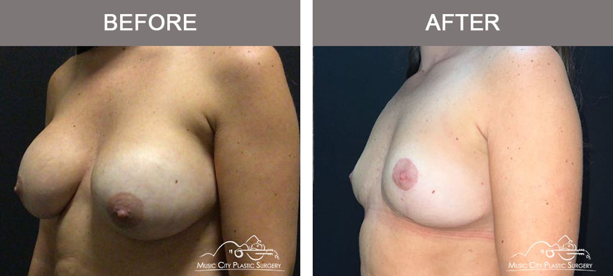 Capsulectomy Before & After Gallery - Patient 161018 - Image 4