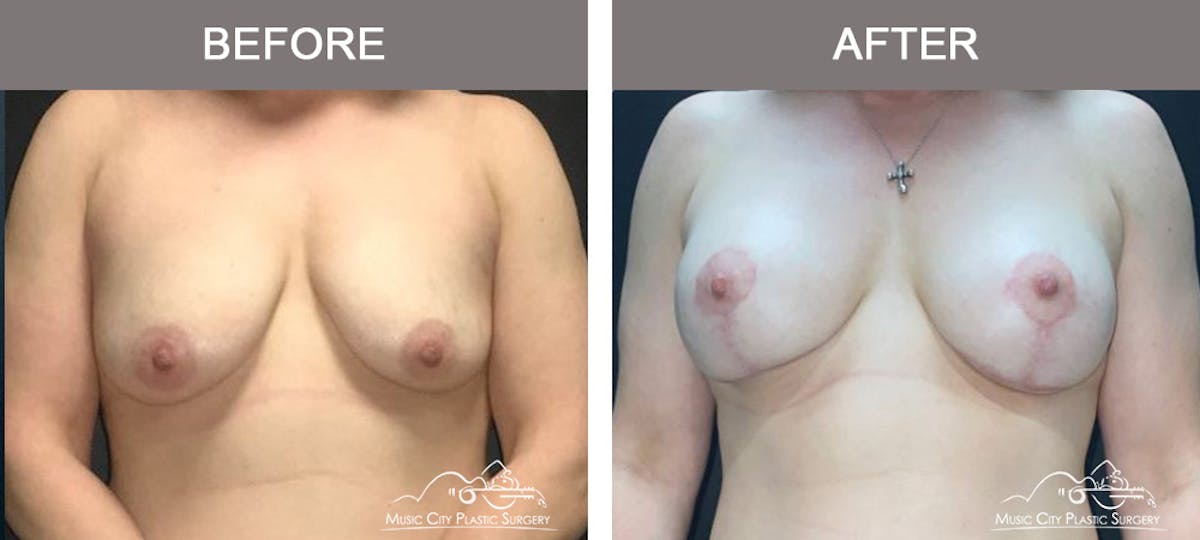 Liposuction Before & After Gallery - Patient 704023 - Image 1