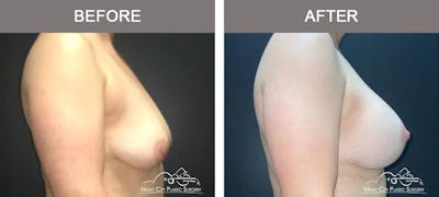 Liposuction Before & After Gallery - Patient 704023 - Image 3