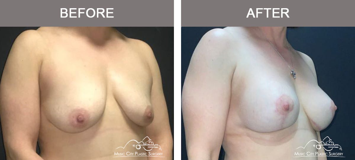 Liposuction Before & After Gallery - Patient 704023 - Image 2