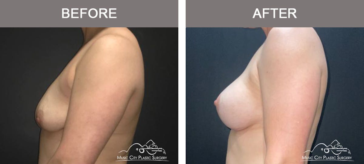 Liposuction Before & After Gallery - Patient 704023 - Image 5