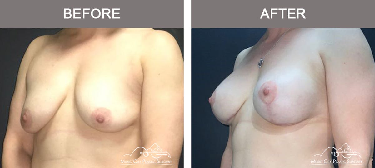 Liposuction Before & After Gallery - Patient 704023 - Image 4