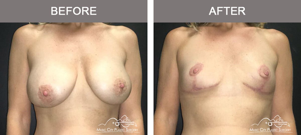 Capsulectomy Before & After Gallery - Patient 160008 - Image 1