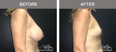 Capsulectomy Before & After Gallery - Patient 160008 - Image 3