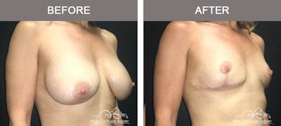 Capsulectomy Before & After Gallery - Patient 160008 - Image 2
