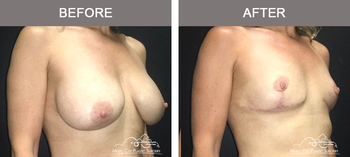 Breast Lift Before & After Gallery - Patient 166280 - Image 2