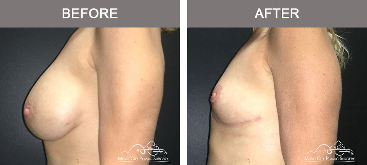 Breast Lift Before & After Gallery - Patient 166280 - Image 5