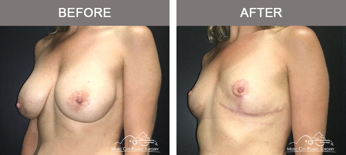 Breast Lift Before & After Gallery - Patient 166280 - Image 4