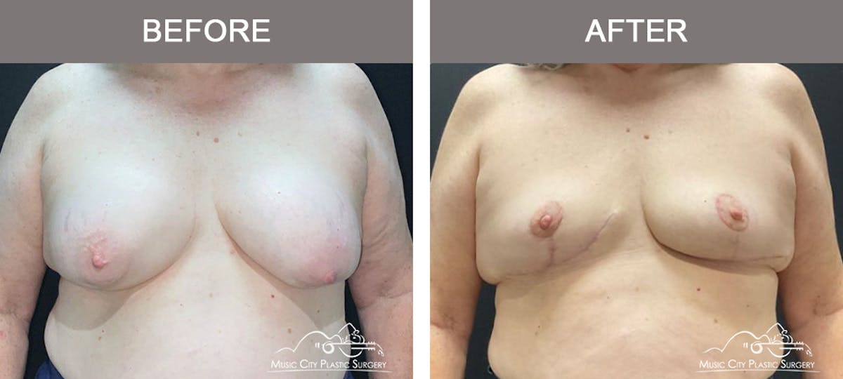 Breast Lift Before & After Gallery - Patient 359228 - Image 1