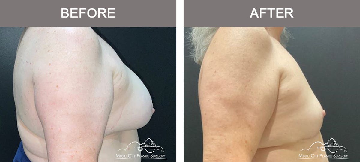 Breast Lift Before & After Gallery - Patient 359228 - Image 3