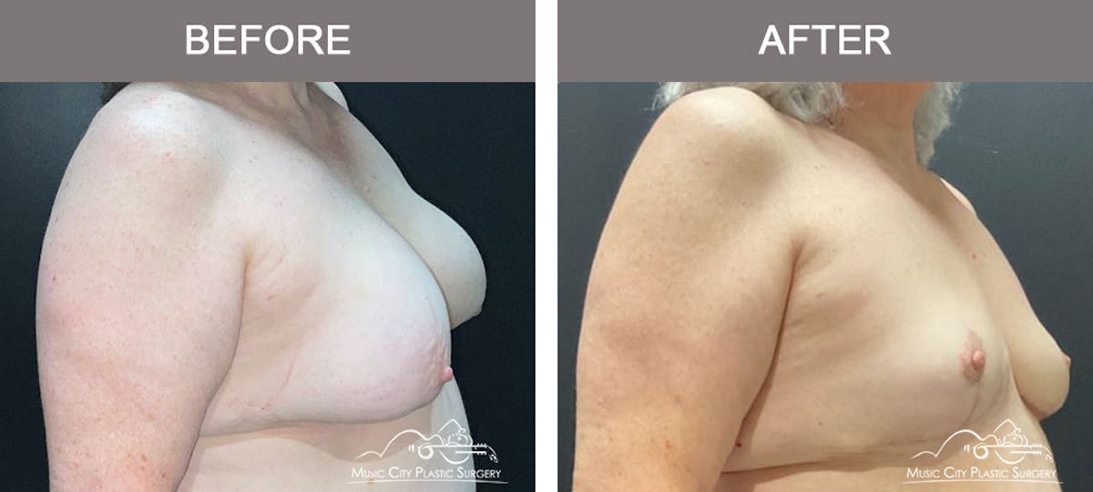 Capsulectomy Before & After Gallery - Patient 198057 - Image 2