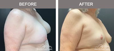 Capsulectomy Before & After Gallery - Patient 198057 - Image 2