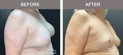 Breast Lift Before & After Gallery - Patient 359228 - Image 2