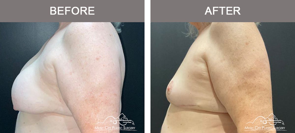 Breast Lift Before & After Gallery - Patient 359228 - Image 5