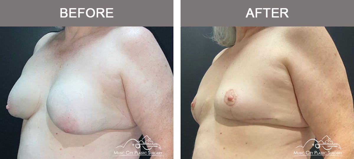 Breast Lift Before & After Gallery - Patient 359228 - Image 4