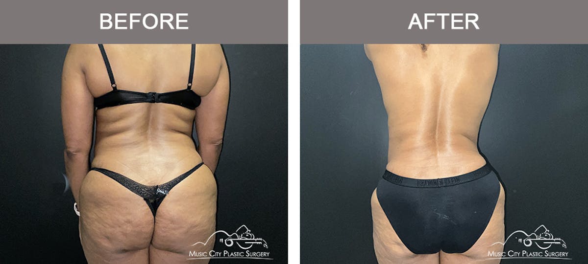 Liposuction Before & After Gallery - Patient 429488 - Image 1