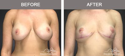 Breast Lift Before & After Gallery - Patient 221948 - Image 1
