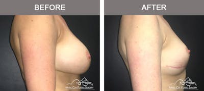 Breast Lift Before & After Gallery - Patient 221948 - Image 3