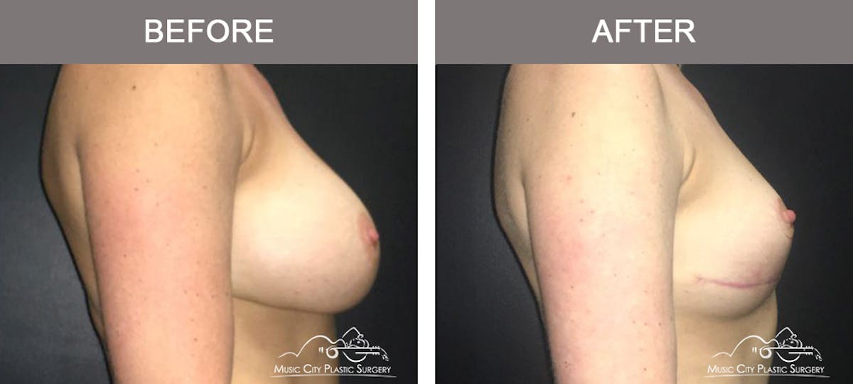 Breast Lift Before & After Gallery - Patient 221948 - Image 3