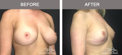 Breast Lift Before & After Gallery - Patient 221948 - Image 2