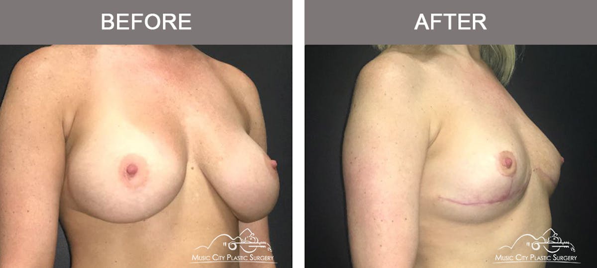 Breast Lift Before & After Gallery - Patient 221948 - Image 2