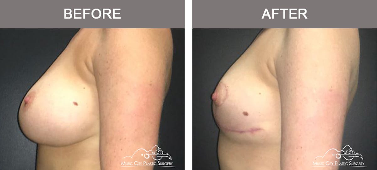 Breast Lift Before & After Gallery - Patient 221948 - Image 5