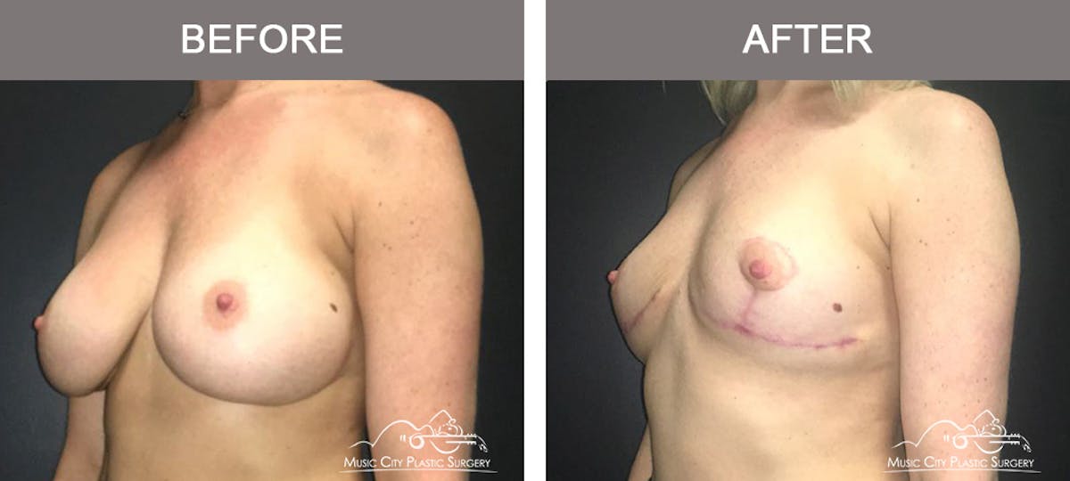 Breast Lift Before & After Gallery - Patient 221948 - Image 4