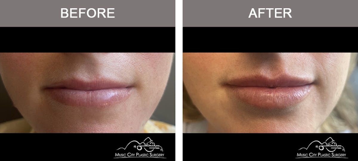 Dermal Fillers Before & After Gallery - Patient 170360 - Image 1