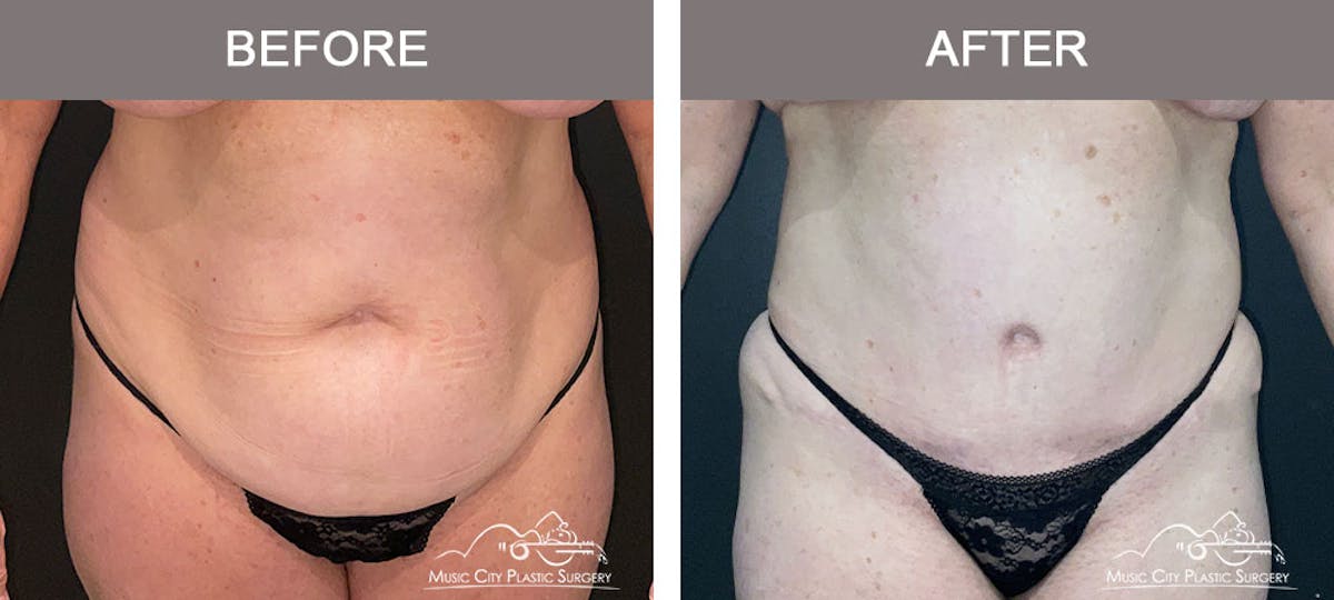 Abdominoplasty Before & After Gallery - Patient 274195 - Image 1