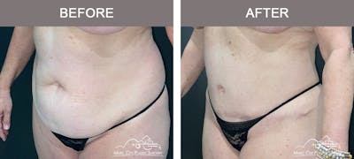 Abdominoplasty Before & After Gallery - Patient 274195 - Image 2