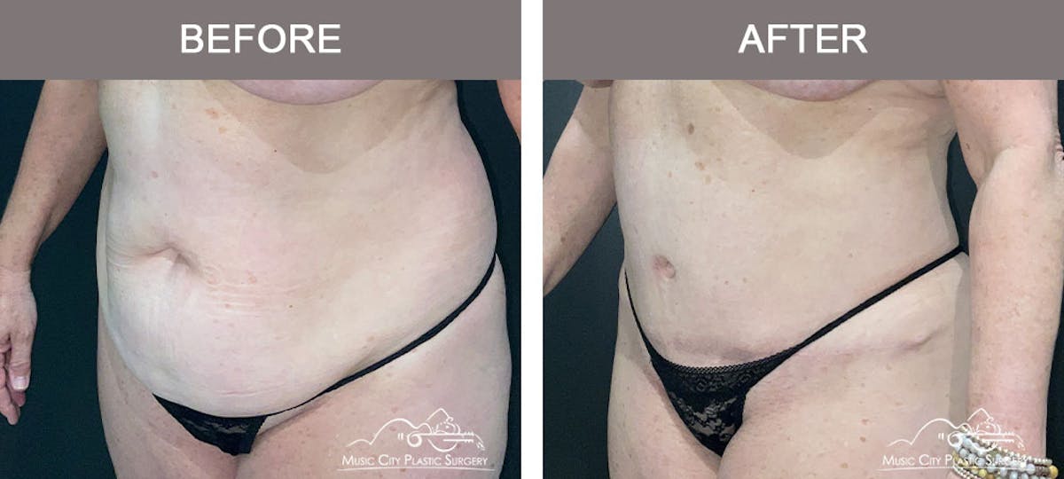 Abdominoplasty Before & After Gallery - Patient 274195 - Image 2