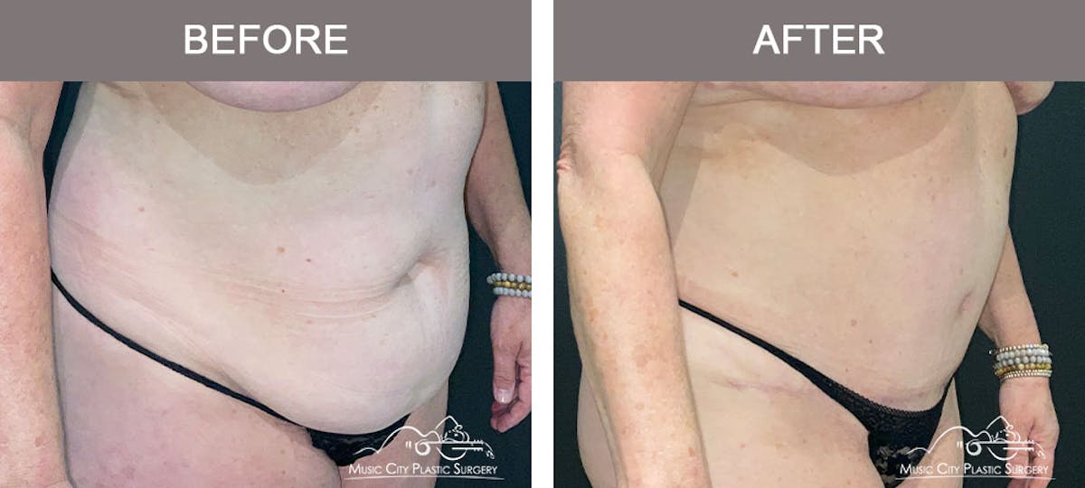 Abdominoplasty Before & After Gallery - Patient 274195 - Image 4