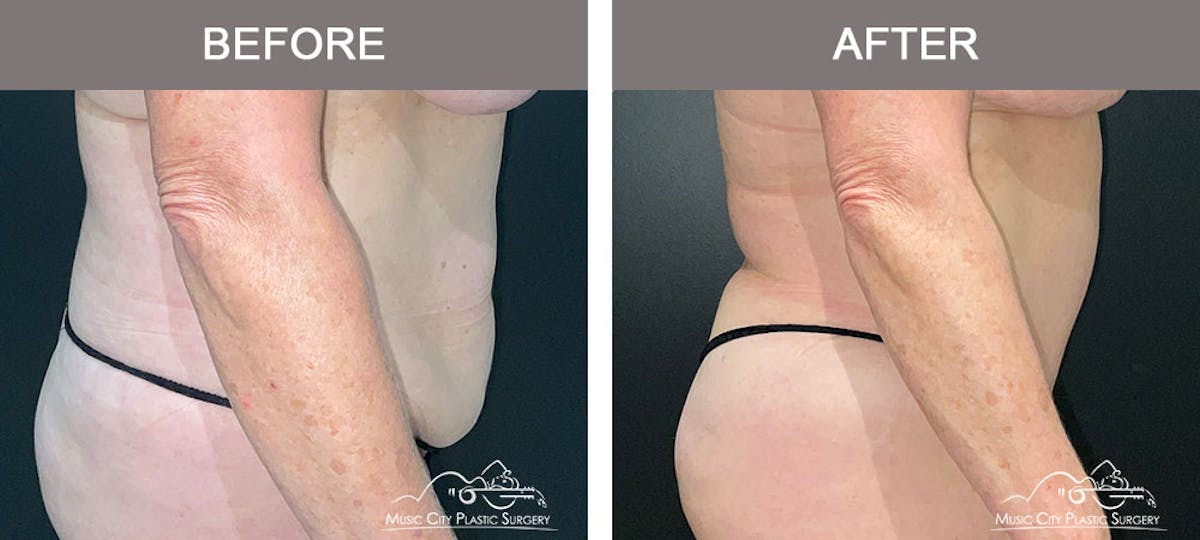 Abdominoplasty Before & After Gallery - Patient 274195 - Image 5