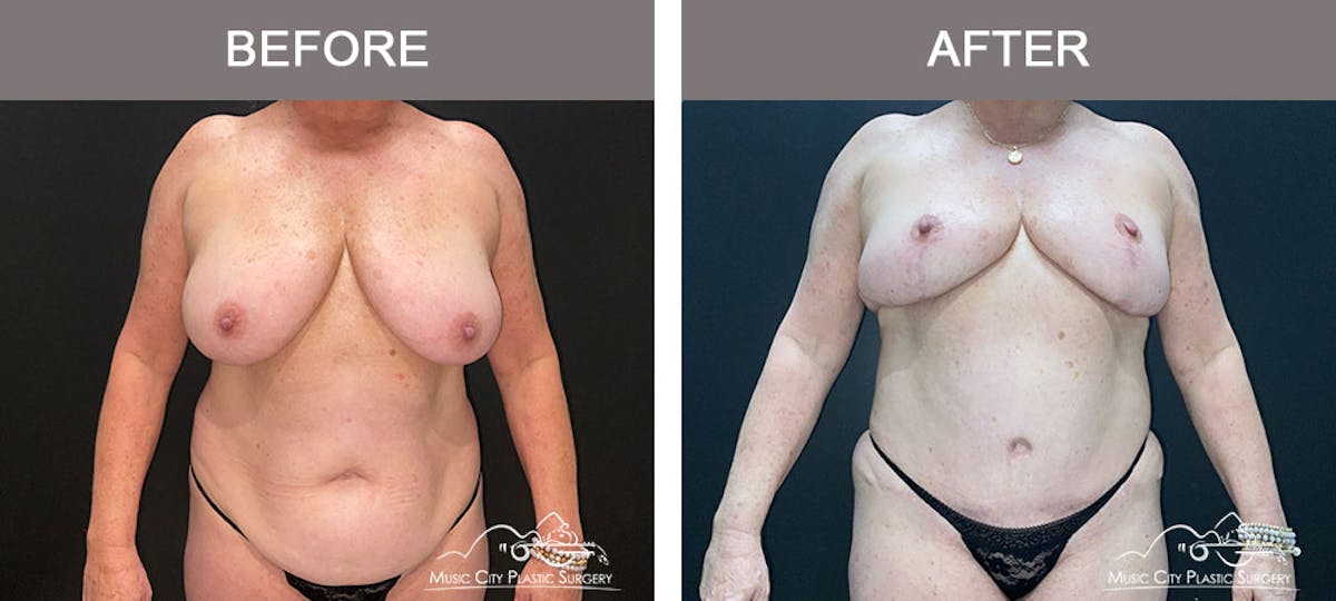 Liposuction Before & After Gallery - Patient 909455 - Image 1