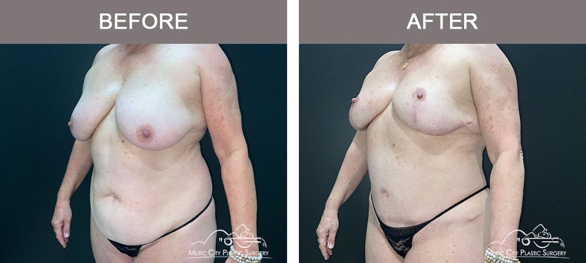 Liposuction Before & After Gallery - Patient 909455 - Image 2