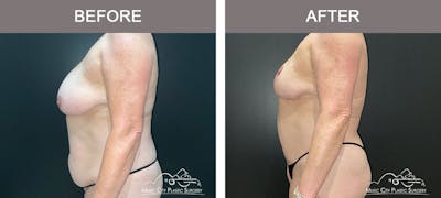 Liposuction Before & After Gallery - Patient 909455 - Image 3