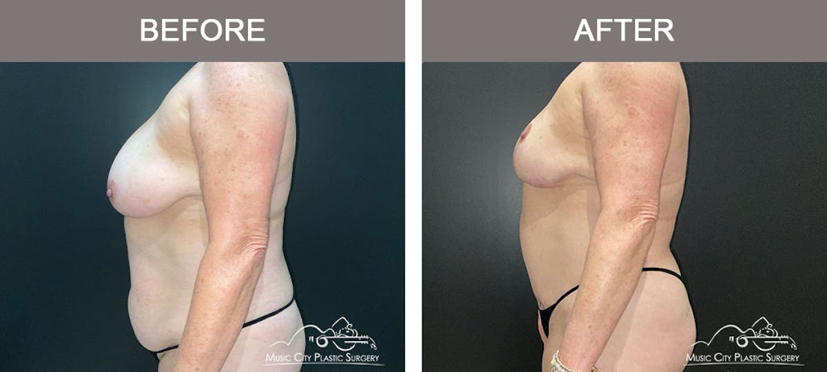 Liposuction Before & After Gallery - Patient 909455 - Image 3