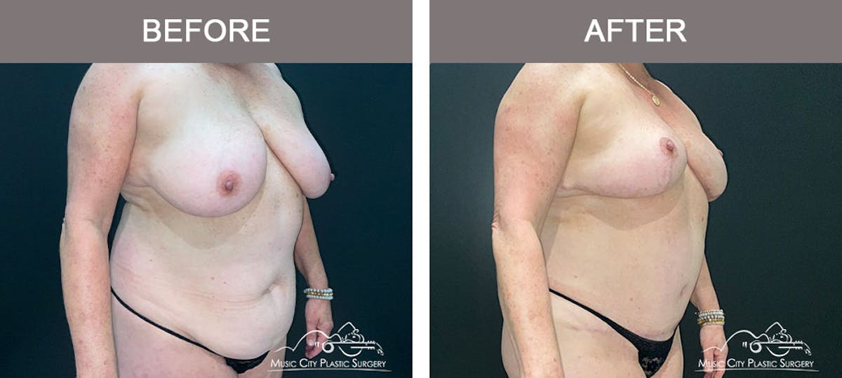 Liposuction Before & After Gallery - Patient 909455 - Image 4