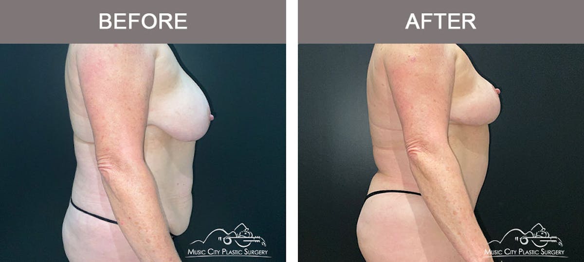 Liposuction Before & After Gallery - Patient 909455 - Image 5