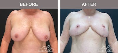 Breast Reduction Before & After Gallery - Patient 141815 - Image 1