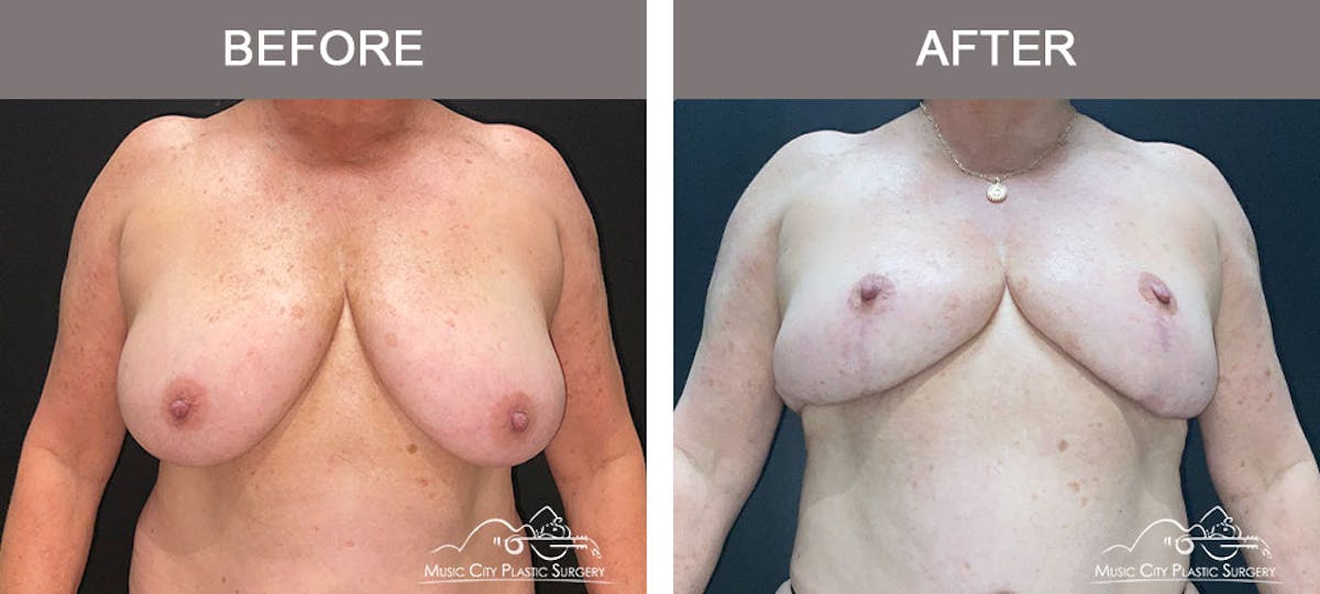 Breast Reduction Before & After Gallery - Patient 141815 - Image 1
