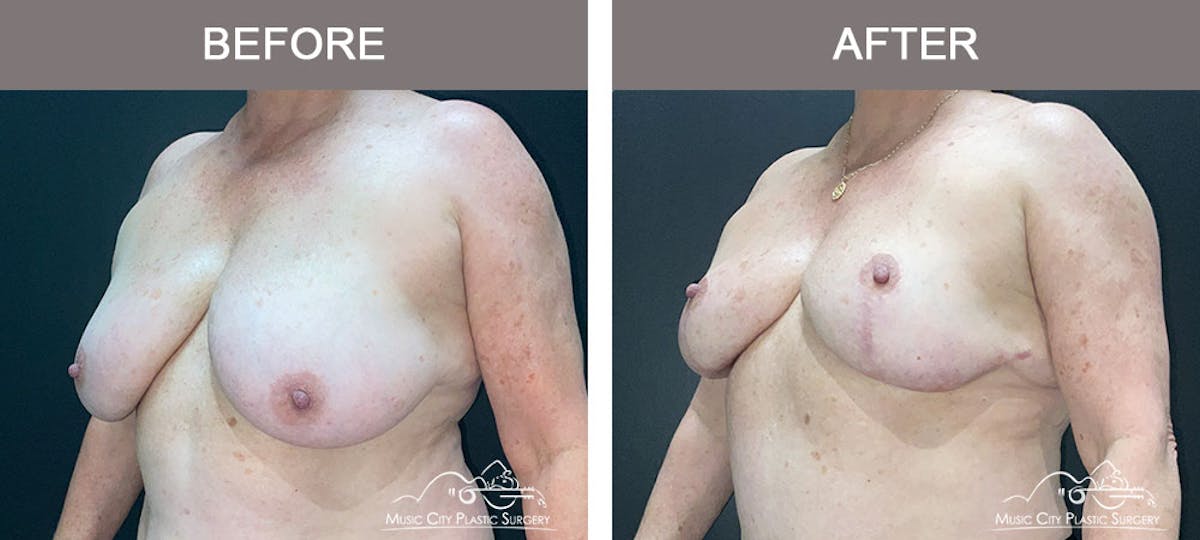Breast Reduction Before & After Gallery - Patient 141815 - Image 2