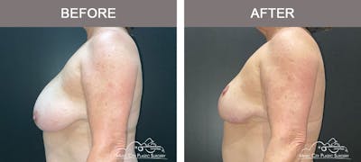 Breast Reduction Before & After Gallery - Patient 141815 - Image 3