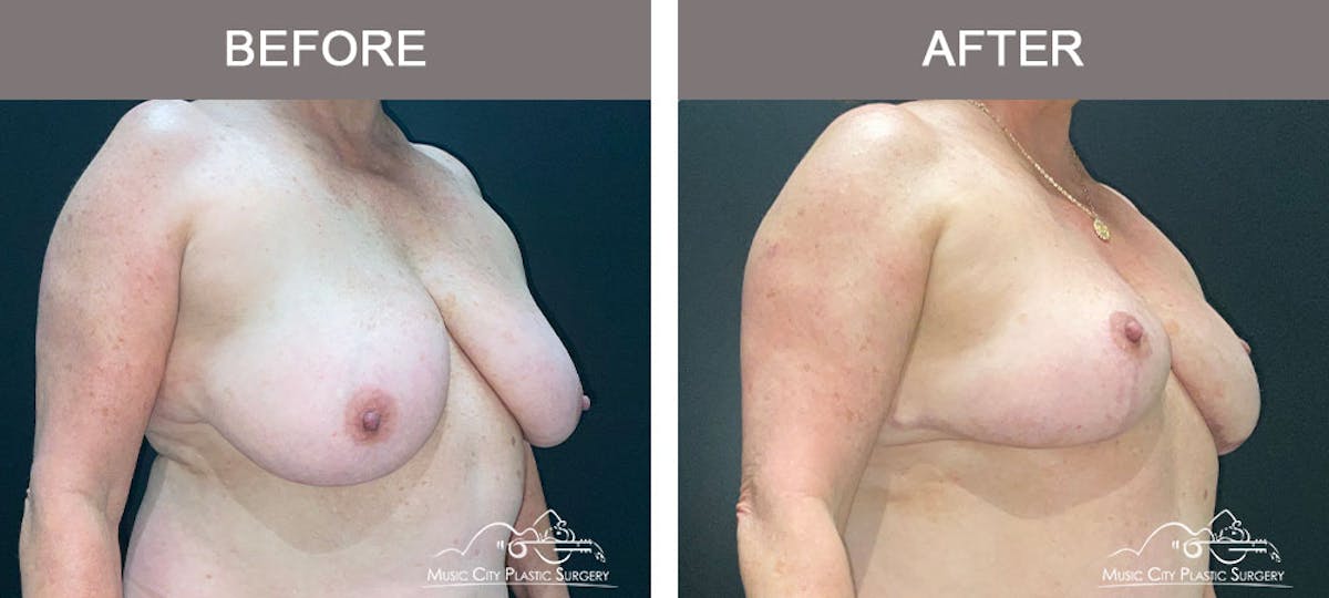 Breast Reduction Before & After Gallery - Patient 141815 - Image 4