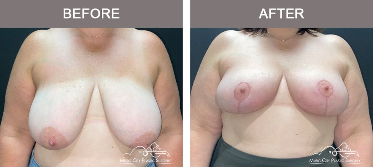 Breast Reduction Before & After Gallery - Patient 103446 - Image 1