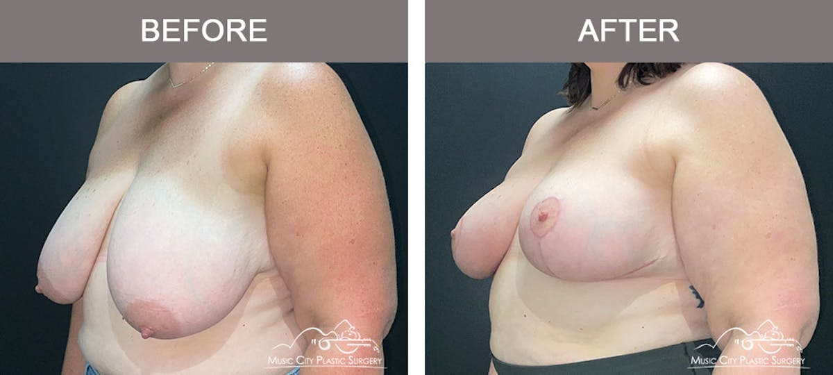 Breast Reduction Before & After Gallery - Patient 103446 - Image 2