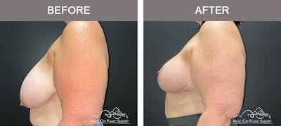 Breast Reduction Before & After Gallery - Patient 103446 - Image 3