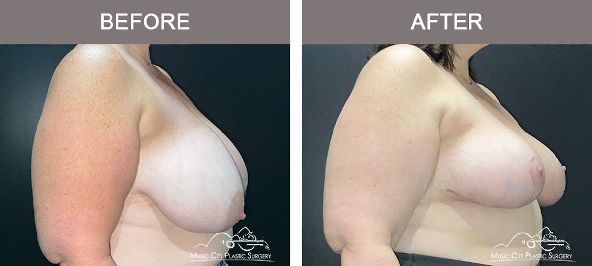 Breast Reduction Before & After Gallery - Patient 103446 - Image 4