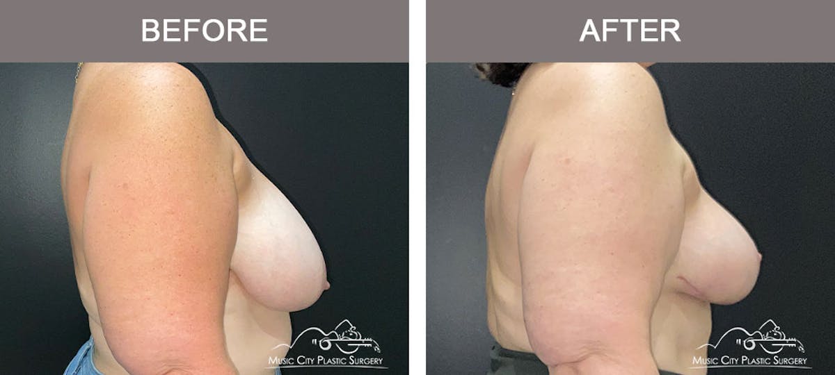 Breast Reduction Before & After Gallery - Patient 103446 - Image 5