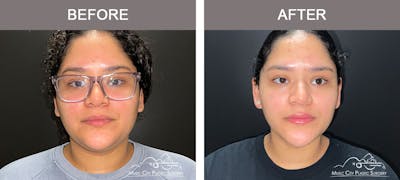 Facial Liposuction Before & After Gallery - Patient 166685 - Image 1